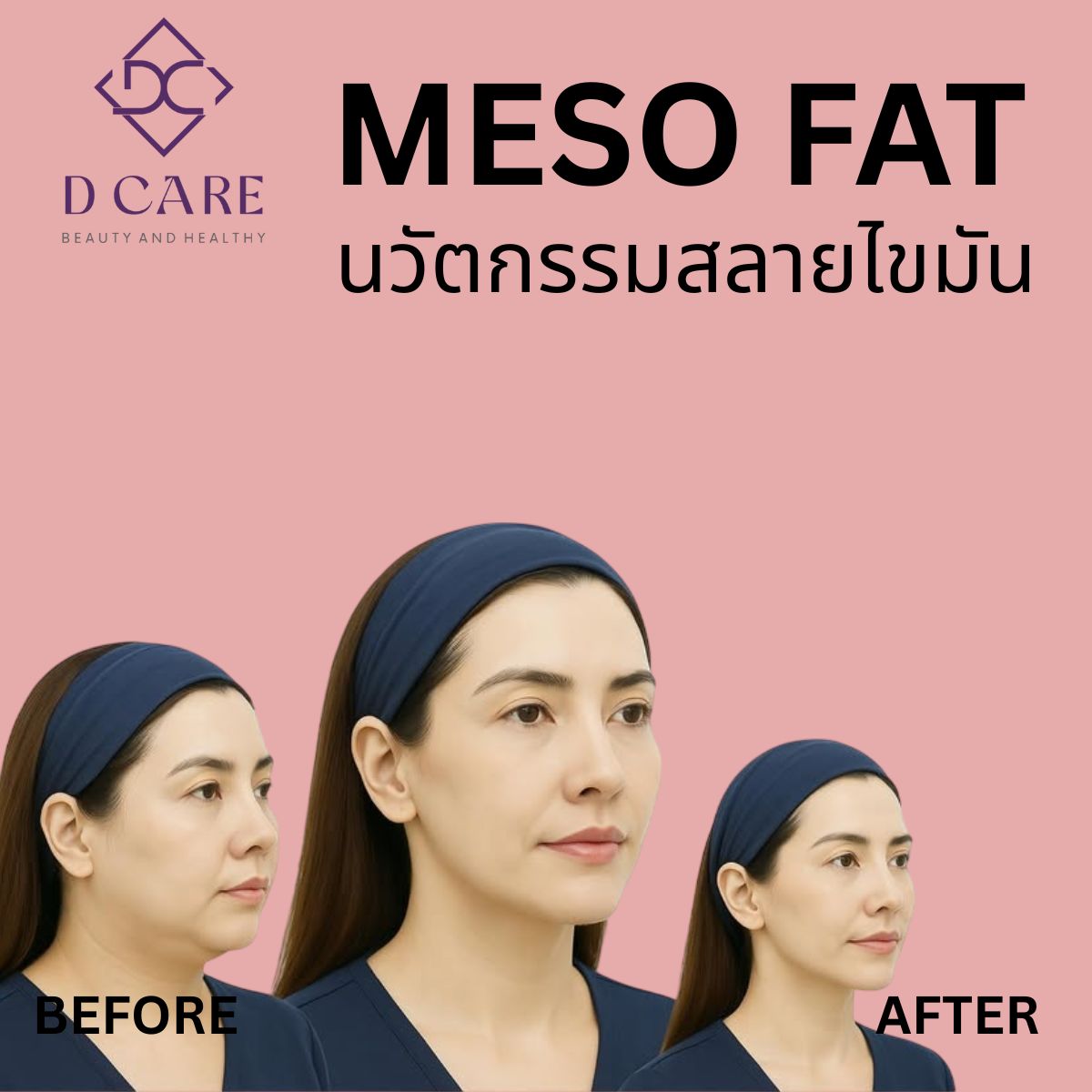MESO FAT : นวัตกรรมสลายไขมัน 